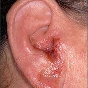 Tinnitus